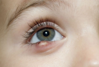 Cara Mengobati Mata Bintitan